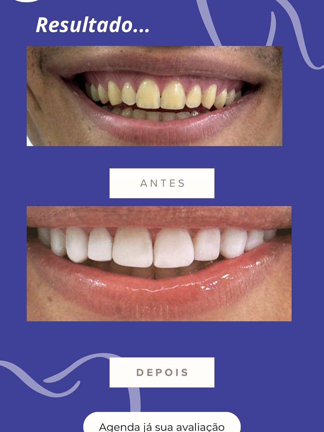 Gengivoplastia