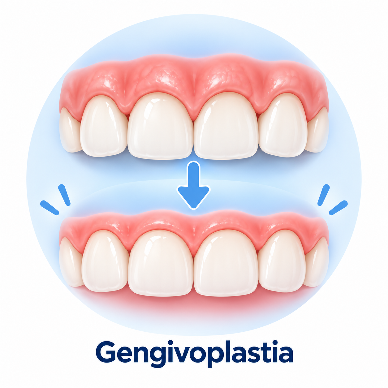 Gengivoplastia